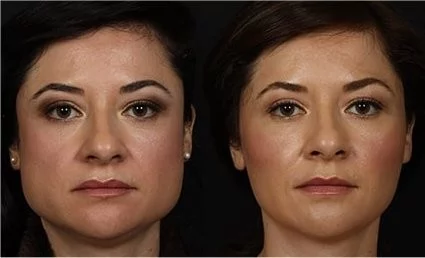 Einleitung: masseter botox vorher nachher und der wachsende Beauty-Trend